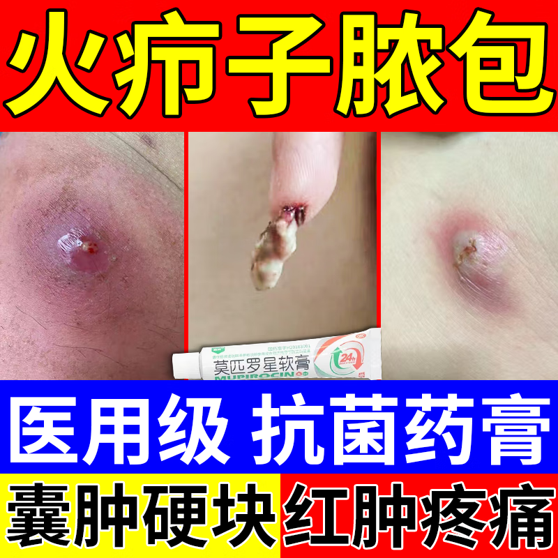 疼痛发热流脓皮脂腺囊肿脓疱抗菌皮肤用药莫匹罗星软膏可搭拔毒i膏 两
