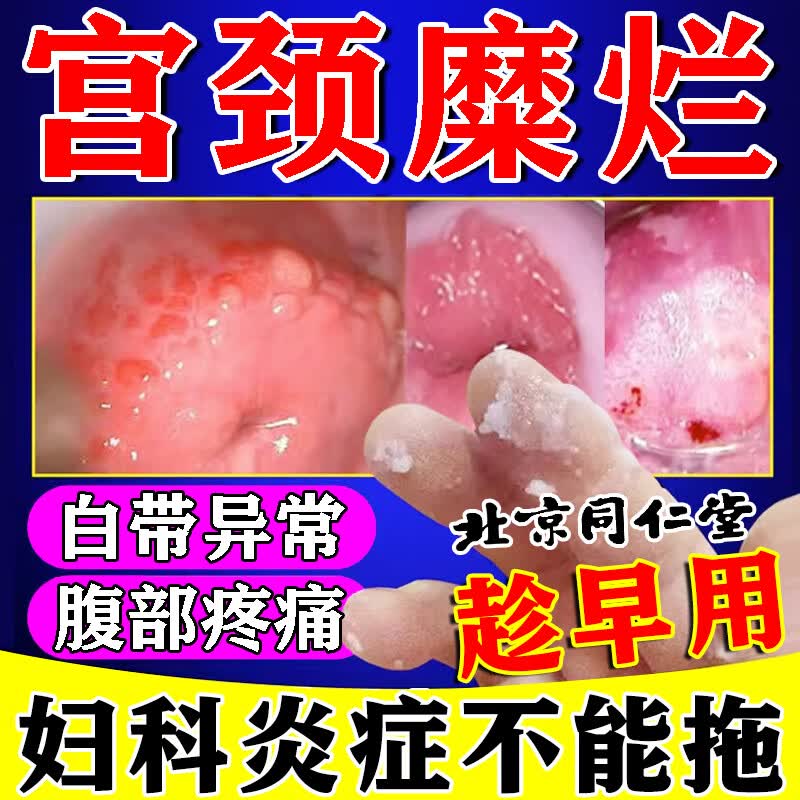宫颈糜烂妇科凝胶抗hpv霉菌性阴道发炎白带多黄有异味阴部瘙痒宫颈炎