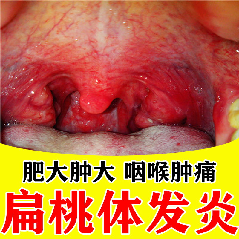 扁桃体发炎特专心用效药  嗓子疼的药治喉咙痛 咽喉炎专用药咽炎慢性咽炎除消肿散结非消炎药根 众生胶囊 1盒装【治咽喉肿痛 建议疗程装】