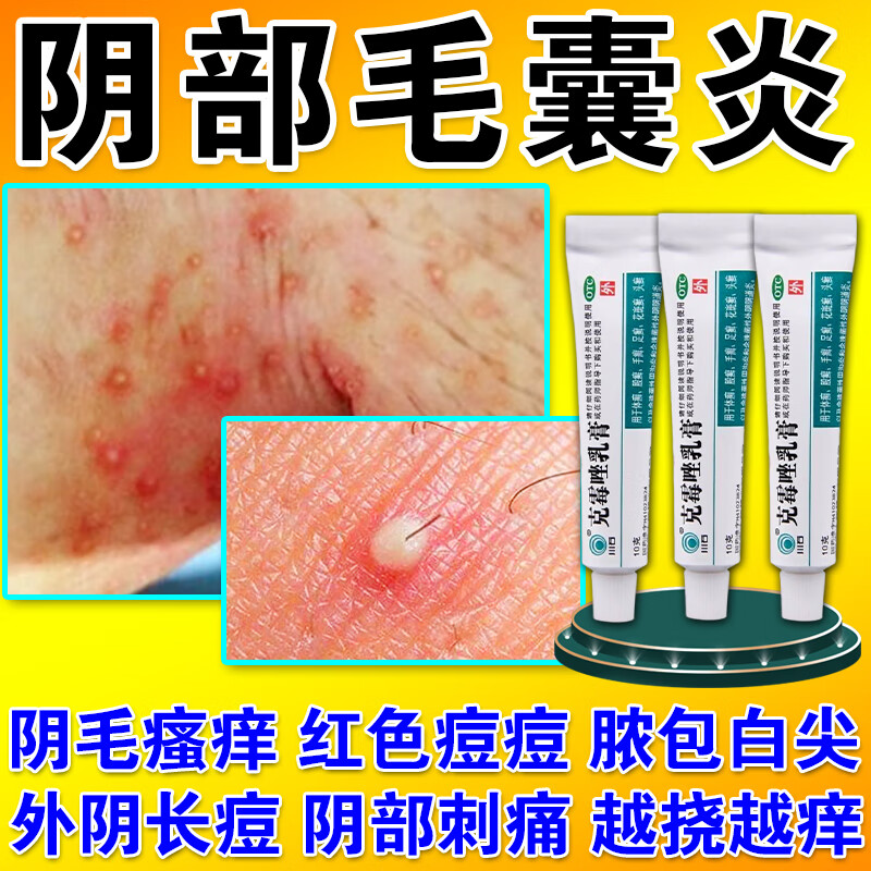 真菌感染阴部毛囊炎药用药膏 治男性女性私处真菌感染毛下瘙痒长疙瘩
