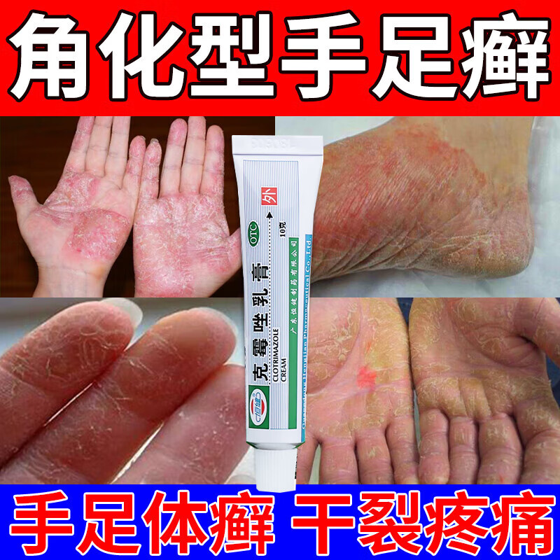 手癣手指关节癣增厚脱皮干裂皮肤瘙痒皮炎湿疹真菌感染止痒脱皮烂脚yx