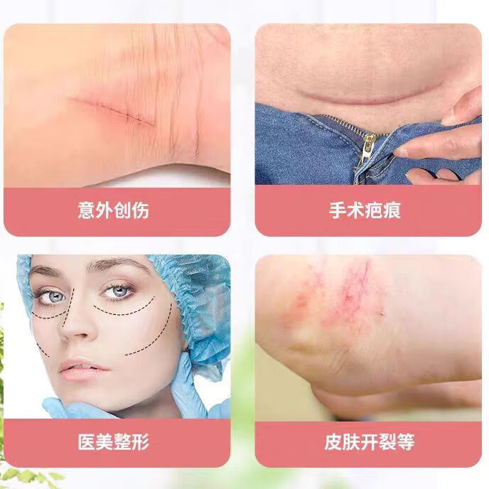 奥嘉莱医用伤口减张贴皮肤专用免缝胶带甲状腺术后剖宫产刀口护理儿童用 【京东物流】大号（12*102mm）1盒10包