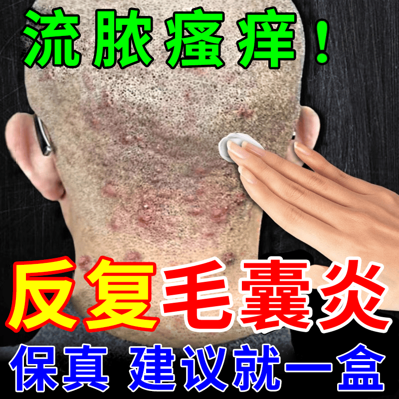头皮毛囊炎头部药头上长疙瘩脓包治毛囊炎药 克林霉素甲硝唑搽剂