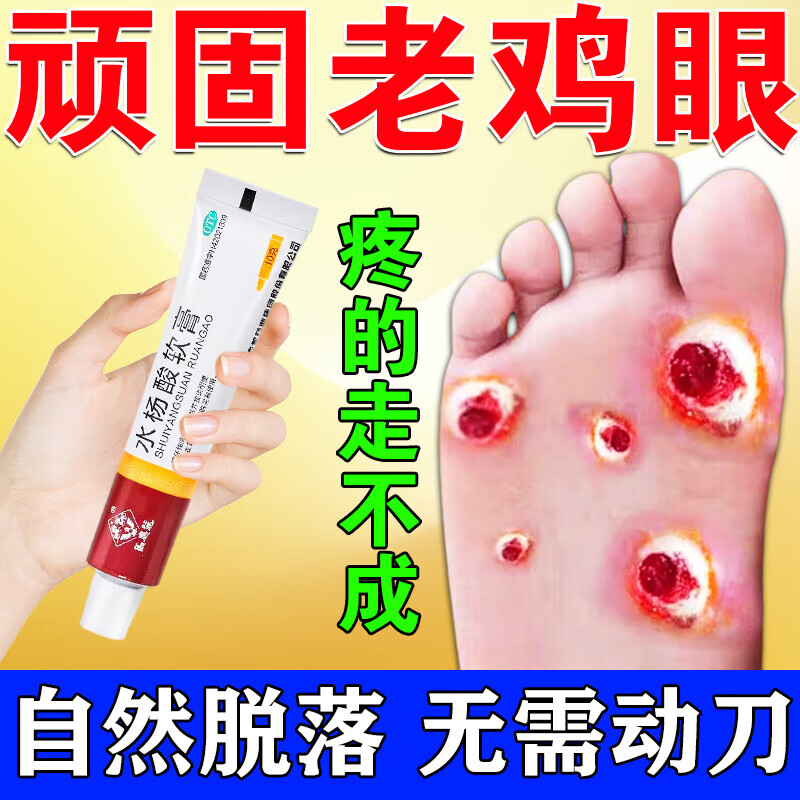 鸡眼药 去肉根肉刺药膏成人脚底脚趾长鸡眼小肉粒疙瘩跖疣猴子老茧