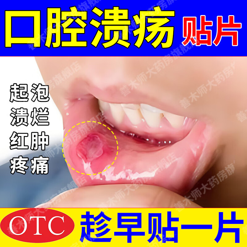口腔溃疡专用药治疗口腔溃疡贴特专傚效药嘴巴反复溃疡嘴里舌头生疮