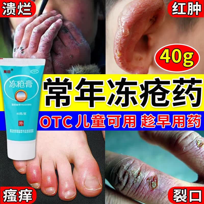 冻疮膏 冻疮专用药膏】成人儿童冻手膏冻伤药消肿止痛冻伤修复手脚