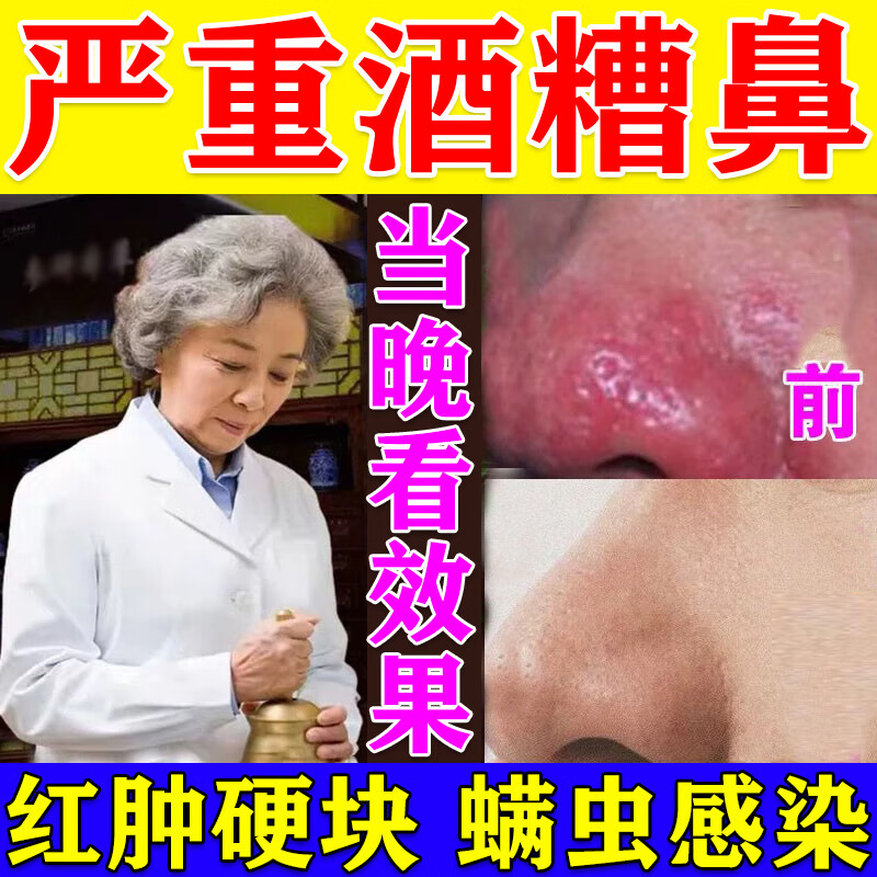 酒渣鼻修复特红鼻子专用效药】根i治酒糟鼻药修复草莓鼻红血丝女鼻子