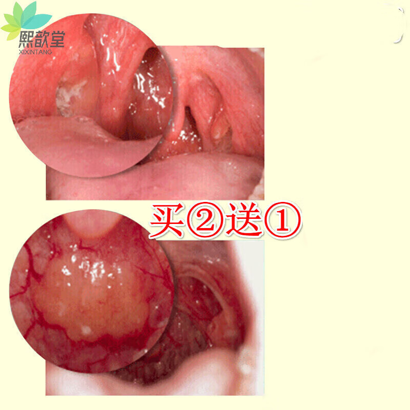 【药房直发】用蜂胶咽喉滤泡喷剂喉咙肿痛干痒嗓子疼有痰声带咽喉喷雾