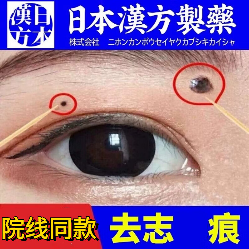 脸部点痣祛痣膏日本非进口点痦子取痣去痣院专用祛斑老年斑手斑日晒斑