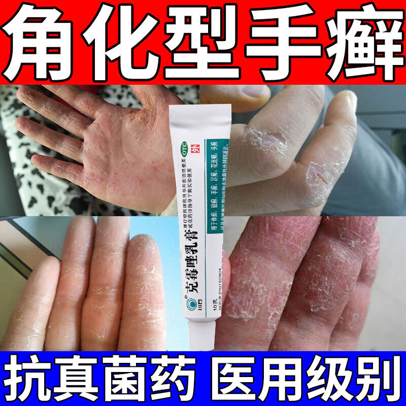 角化型手癣专用药】 手指关手节癣顽固性手癣手掌增厚鳞屑粗糙脱皮