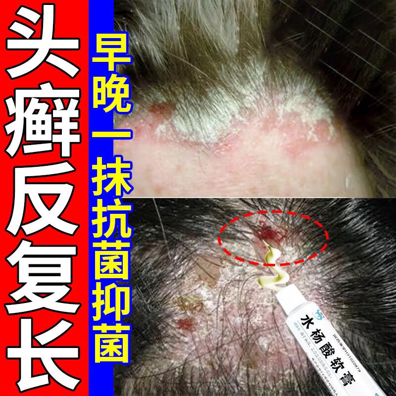 治头癣头皮癣专用药膏头皮痒脂溢性皮炎 头屑头痒头皮癣专用药膏脂溢