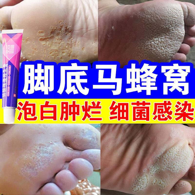 脚气药】专治蜂窝状小孔脚底发白恶臭出汗药膏瘙痒水泡脱皮烂脚丫真菌