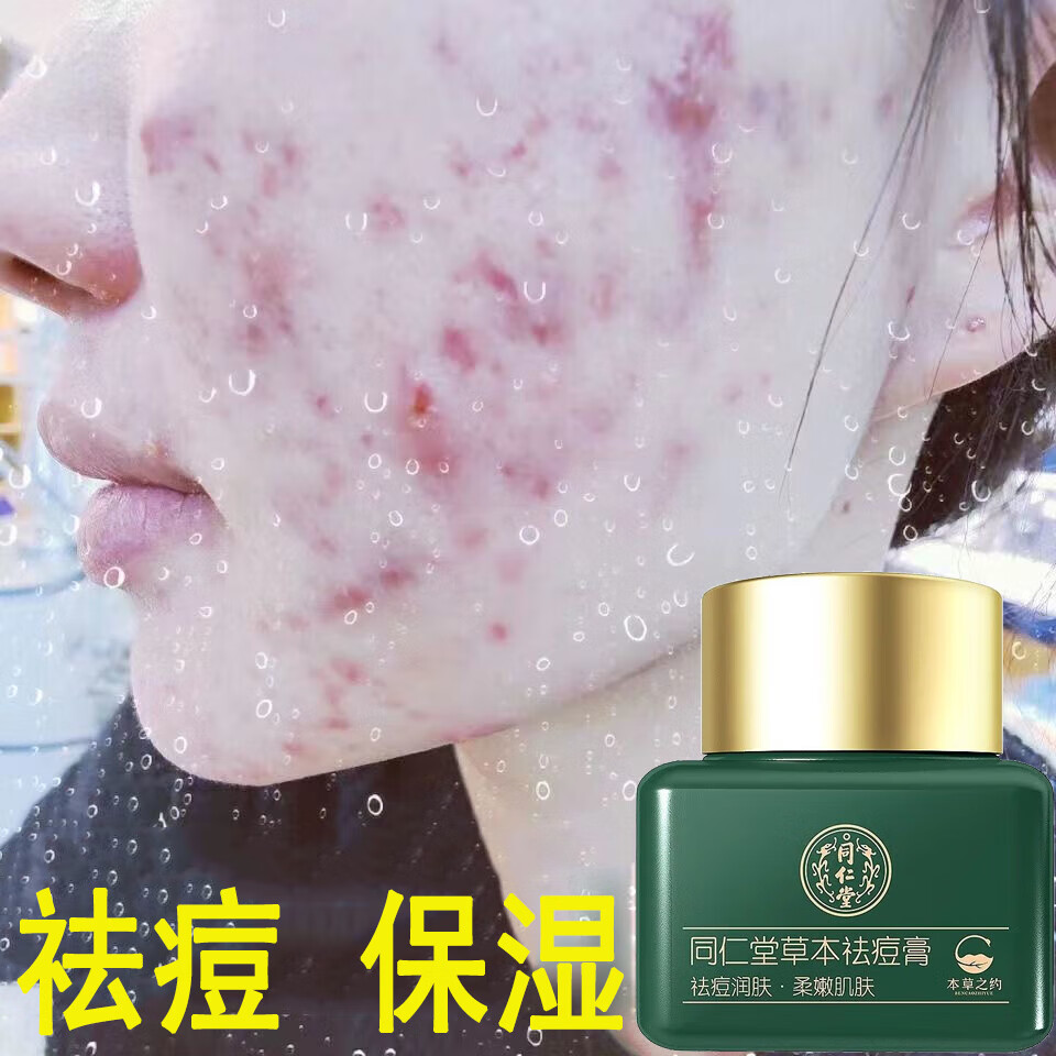 同仁堂祛痘膏保湿淡化面部粉刺闭口痘痘青春祛痘霜20g 一瓶装