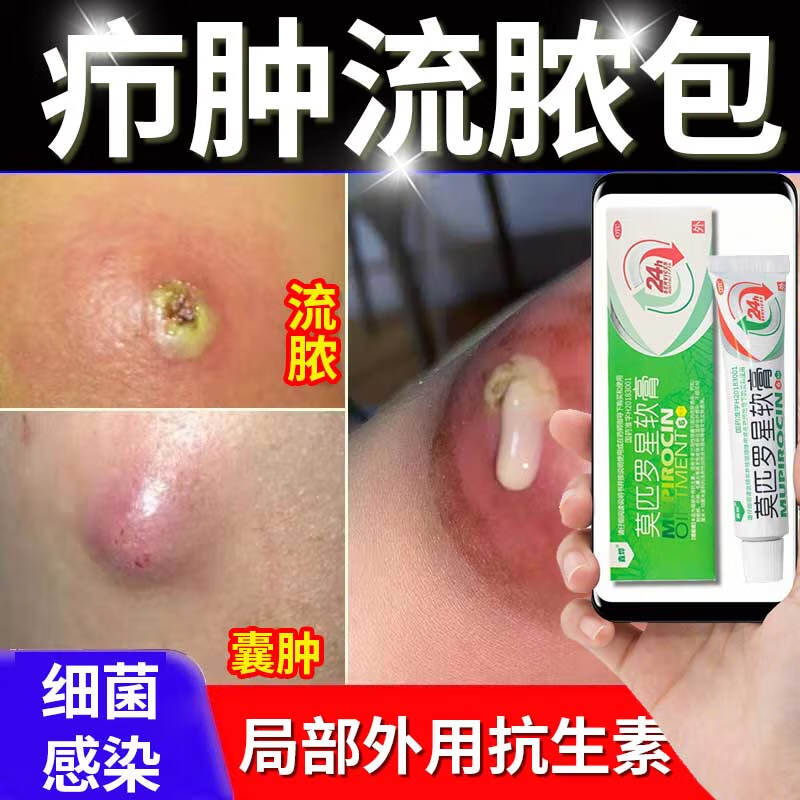 疖肿药膏抗细菌感染局部外用抗生素皮脂腺囊肿成人专用药膏治皮脂腺