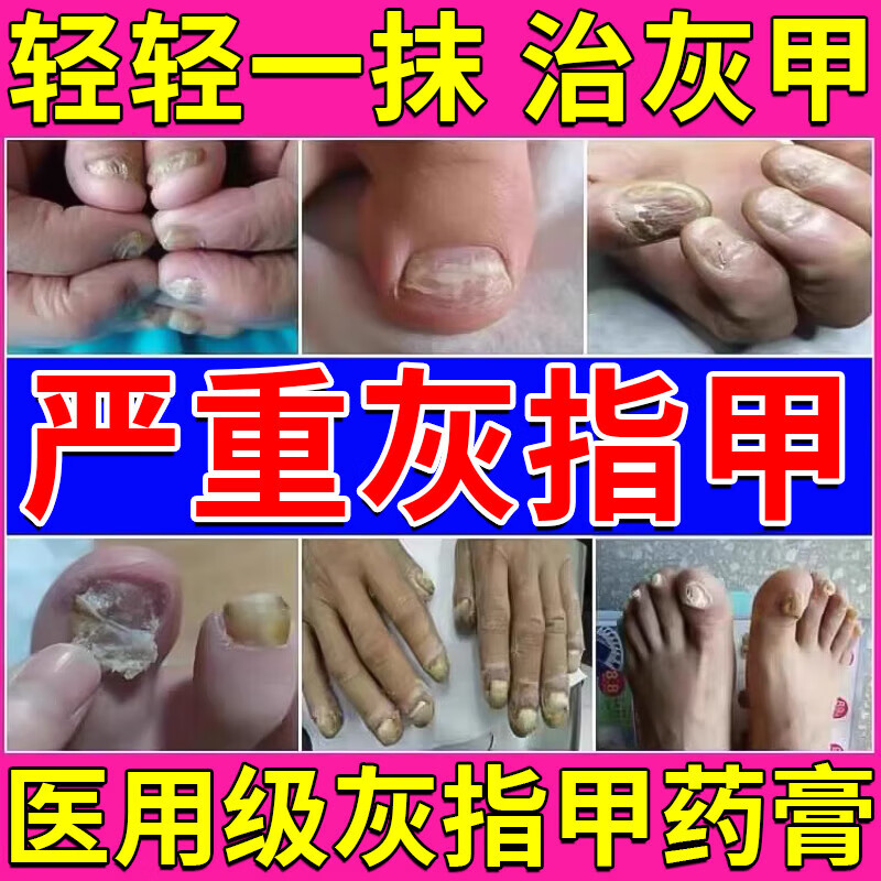 治疗甲癣灰指甲特厚灰指甲脚趾甲药膏 灰指甲专用膏药膏 指甲真菌感染