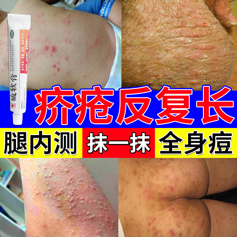 疙瘩皮肤瘙痒止痒疥疮特专效用药 一盒【药品治疗较慢勿着急】尝试装