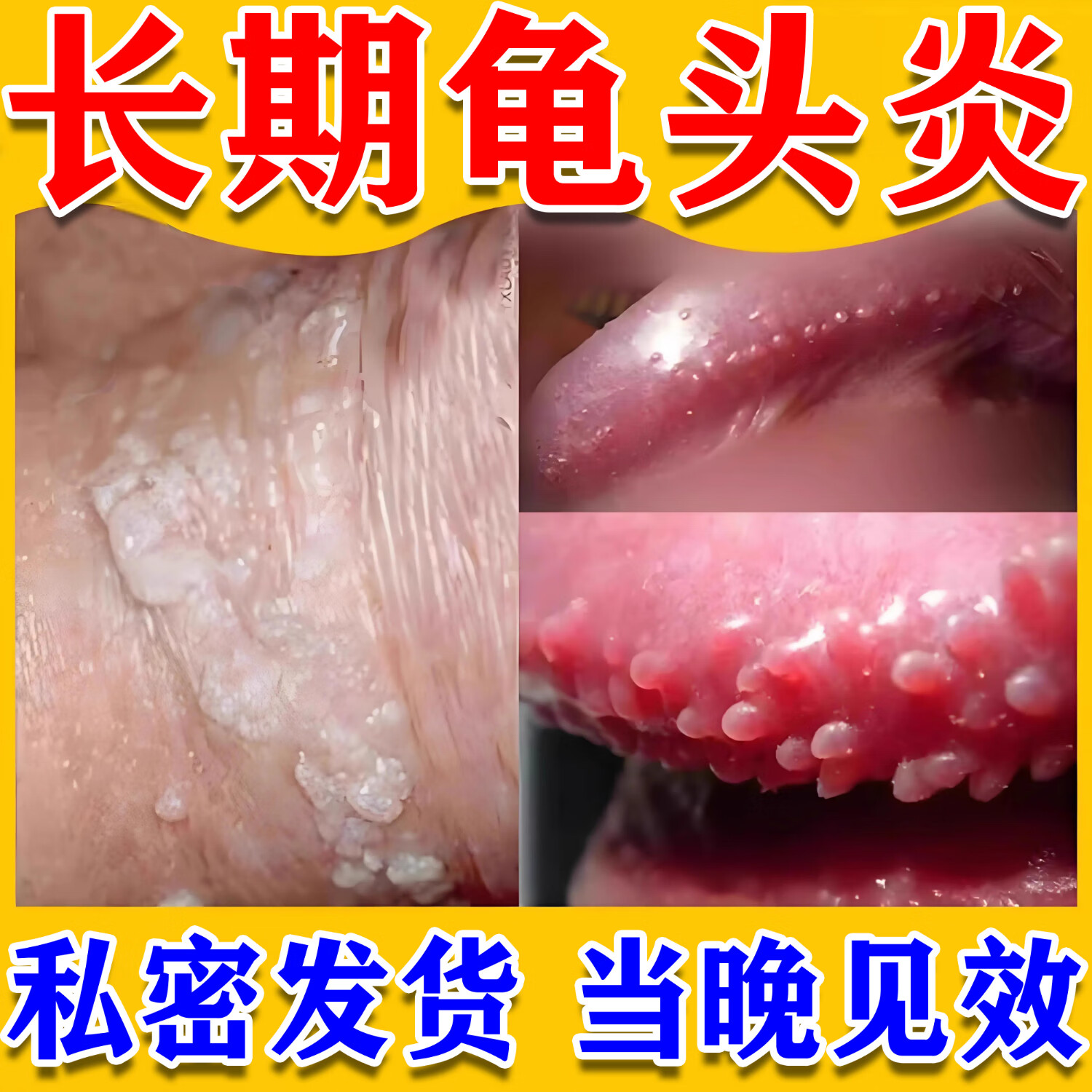 龟头炎专用软膏男士私处阴i囊瘙痒潮湿止包皮炎垢痒红点异味红肿 三盒