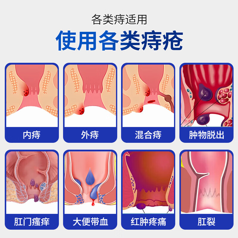 思恩腾瑞贝安痔疮膏肉球凝胶卡波姆痔肉球内外混合痔肛门坠胀瘙痒肛裂便秘充血 痔疮膏1支