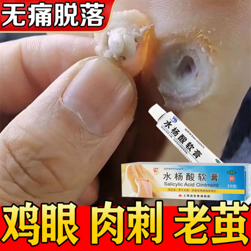 治鸡眼的药鸡眼膏水杨酸软膏鸡眼膏去手指脚趾根肉刺药膏无痛脱落去