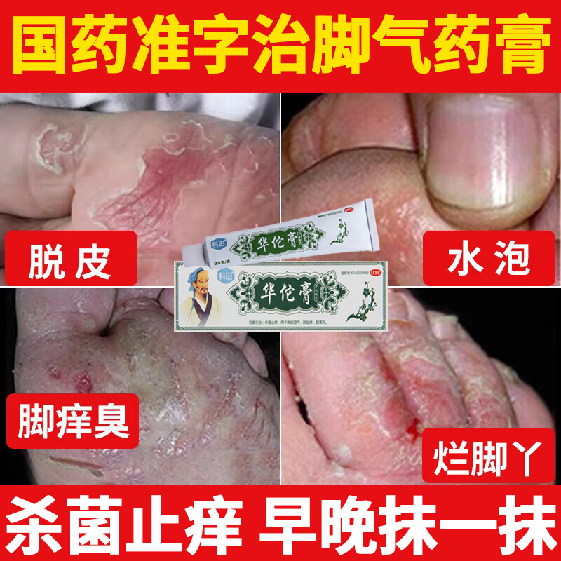 脚气药止痒脱皮烂脚丫 真菌感染皮肤用药 水泡糜烂脚趾缝痒溃烂治疗