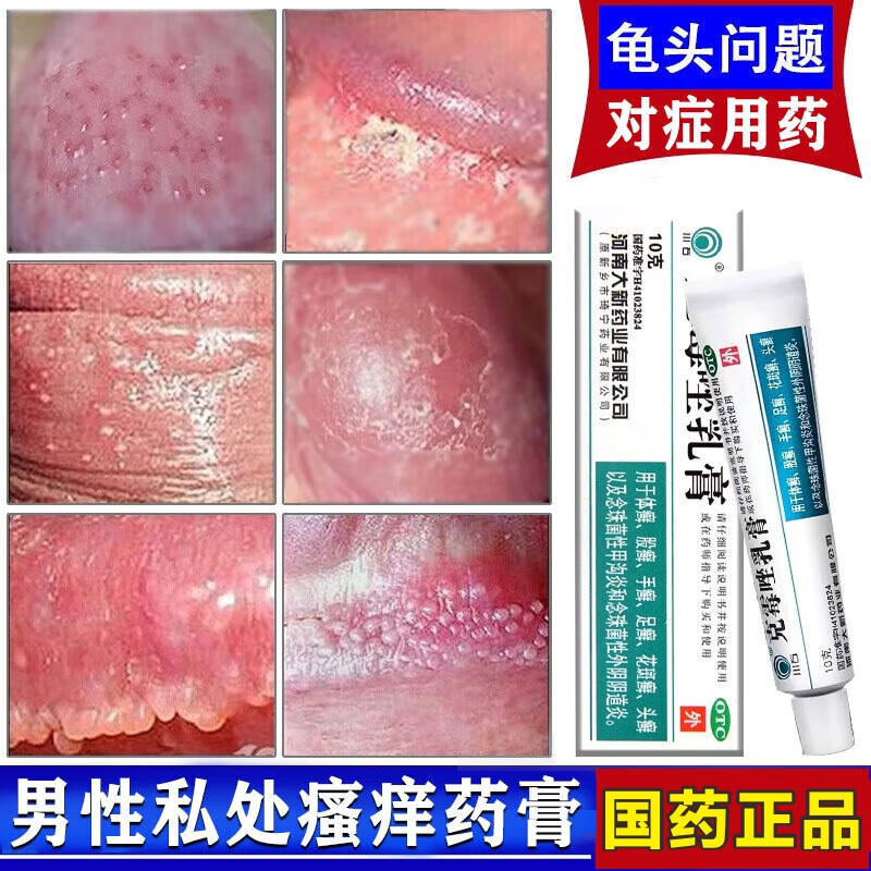 龟头炎用药包皮炎真菌感染 男人私处止痒杀菌药膏龟头发炎珍珠疹红肿