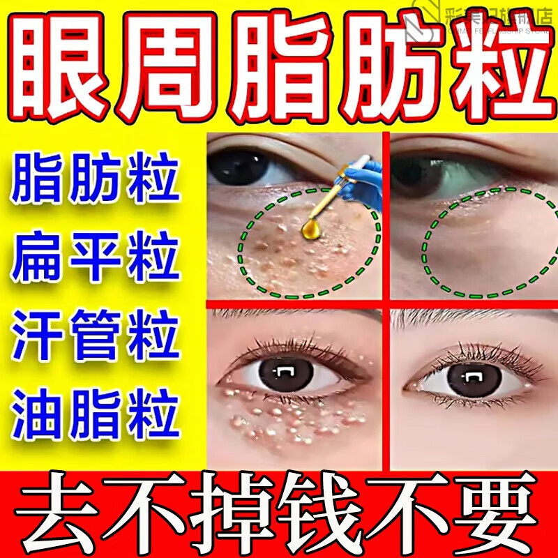 汗管瘤脂肪粒眼部专用去除0汗管瘤眼部去除神器祛眼周脂肪粒专用 1瓶