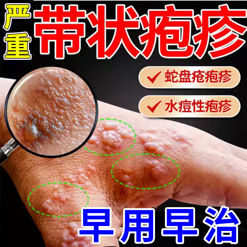 带状疱疹药 蛇盘疮蛇缠腰 带状疱疹后遗症神经痛用药斷根 阿昔洛韦