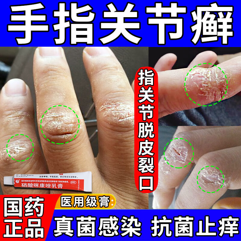 手指关节癣手癣皮肤真菌感染药膏 手指关节皮硬疙瘩手脱皮开裂皮肤