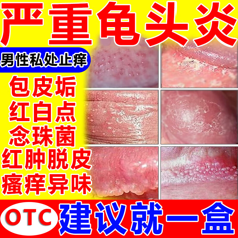 包皮炎症专用药 治疗念珠菌性龟头炎的药 软膏男性私处龟头炎止痒杀菌