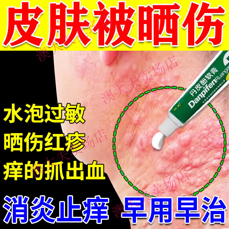 紫外线过敏专用药膏日光性皮炎光敏性皮炎紫外线过敏晒伤皮肤干燥皮肤