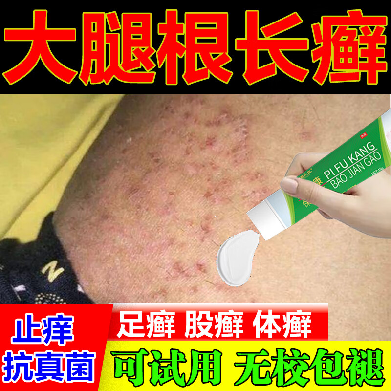 大腿根内侧潮湿瘙痒股癣潮湿异味股癣专用i膏大腿两侧真菌感染长皮癣