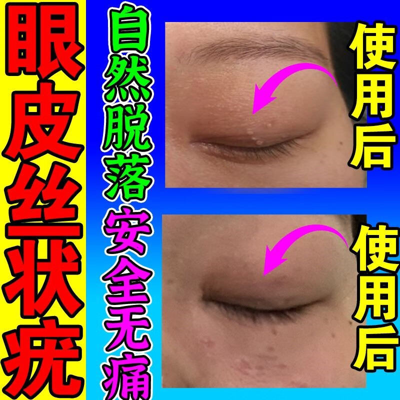 疣眼皮刺猴瘊子肉粒疙瘩去皮赘小肉揪鸦胆子祛疣膏非药品男性跖疣乳