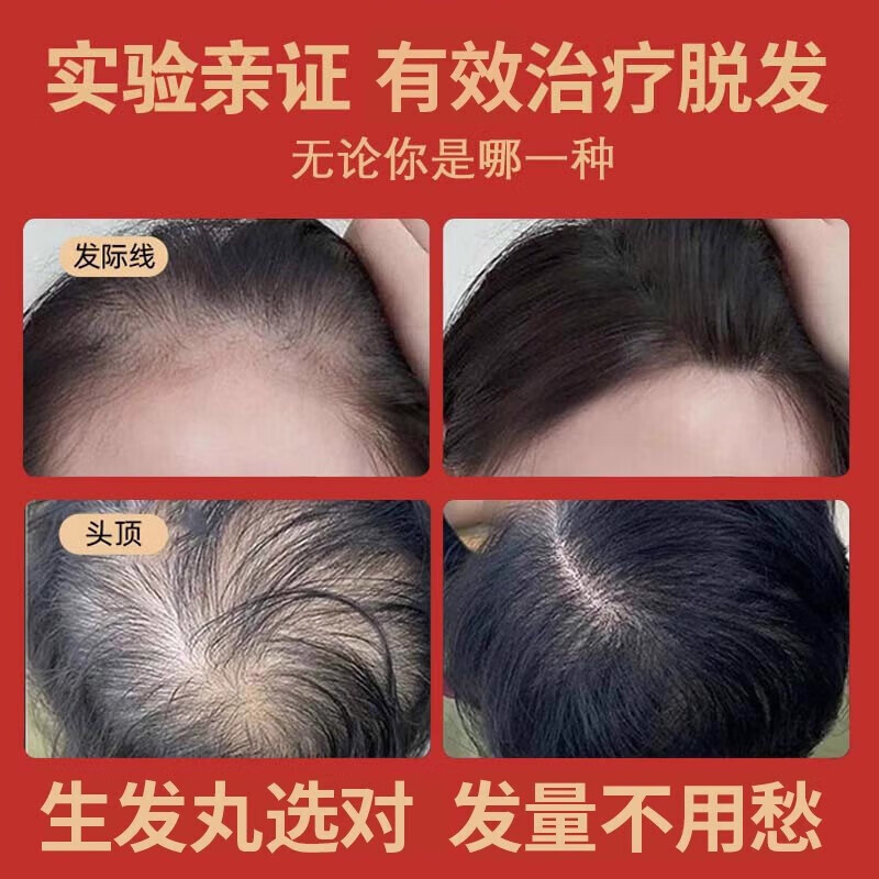 [仁和]固肾生发丸 2.5g*27袋 10盒装 斑秃 全秃 普秃及肝肾虚引起的脱发严重男女专用掉头发的药养血 2.5g*27袋