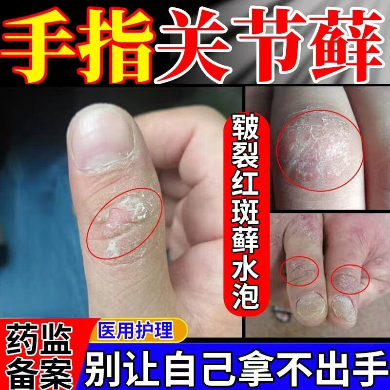 手癣特用傚药手足癣真菌感染药膏脱皮开裂鹅掌风汗疱疹抑菌膏手上起小