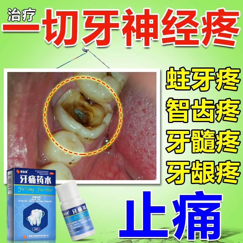 牙痛药快速止痛 牙疼消炎药 一切神经牙痛牙龈烂牙神经蛀牙疼智齿发炎