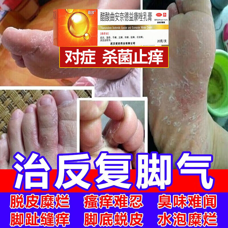治足癣脚气的特痒止痒药 脚气药止痒脱皮烂脚丫真菌感染止痒脚气水泡