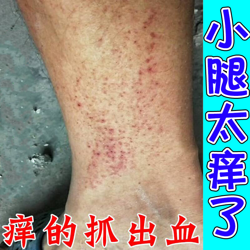 腿痒瘙痒膏小腿皮肤剧烈瘙痒红疹起小疙瘩长红点大腿内侧闷热潮湿瘙痒