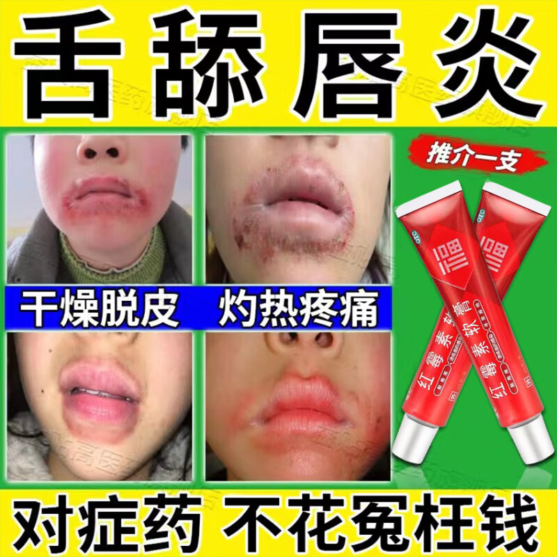 唇炎专用药慢性唇炎嘴唇干裂脱皮结痂起泡出血口角炎烂嘴角口外嘴角