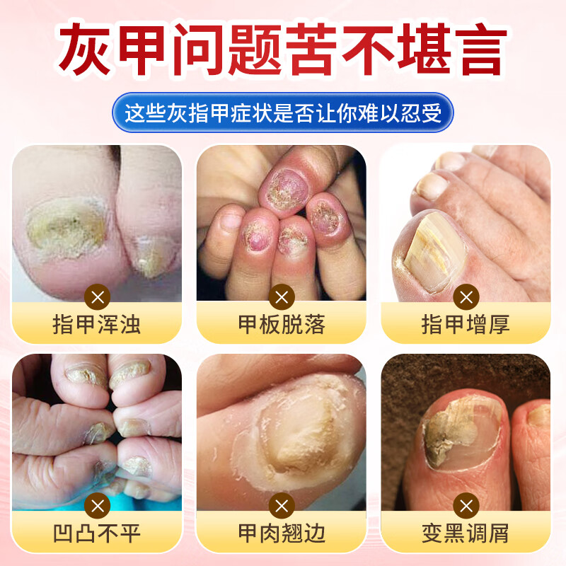 MUESRGTEI德国高端进口灰指甲特殊效去除增厚发黄变空液中草药水灰甲 一盒装【1-2个推荐】