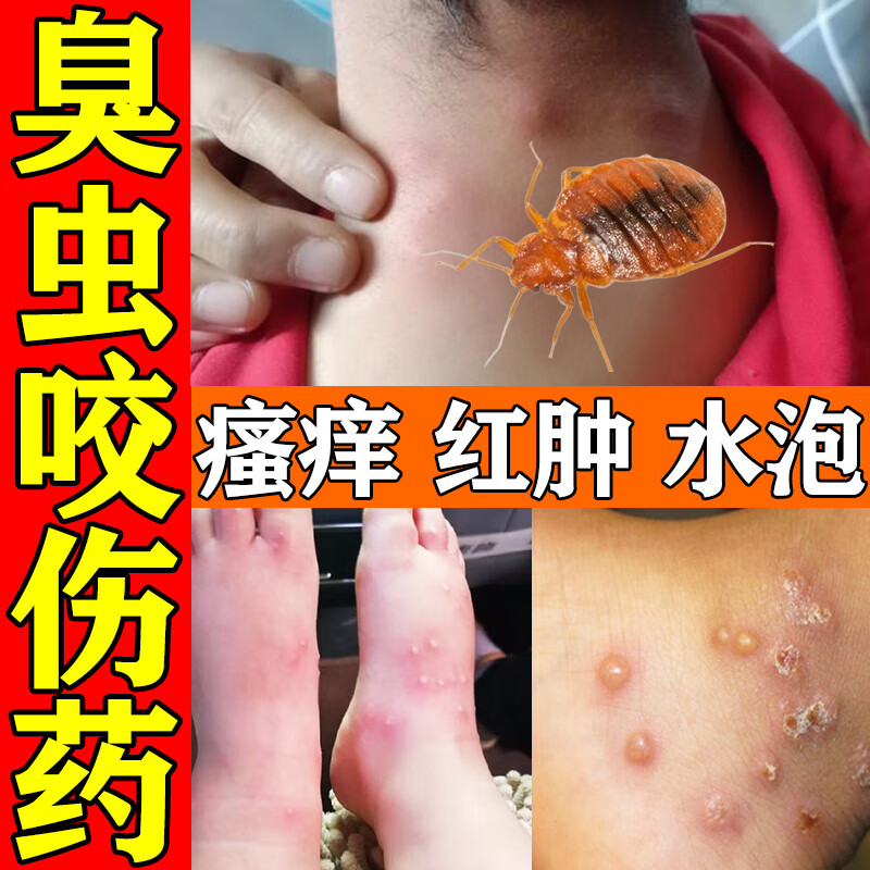 臭虫咬止痒消肿咬臭虫专用药人用 蚊虫叮咬药膏治成人儿童婴儿皮肤