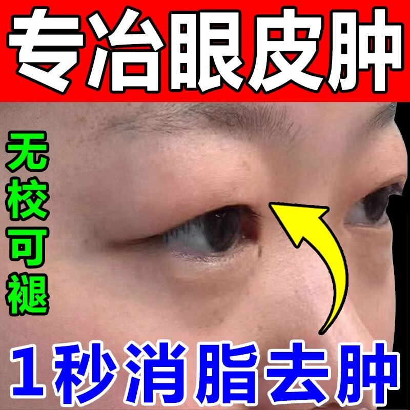 肿眼泡去肿消浮肿去脂肪神器消除眼睛去浮肿水肿上眼皮过敏消脂贴 1