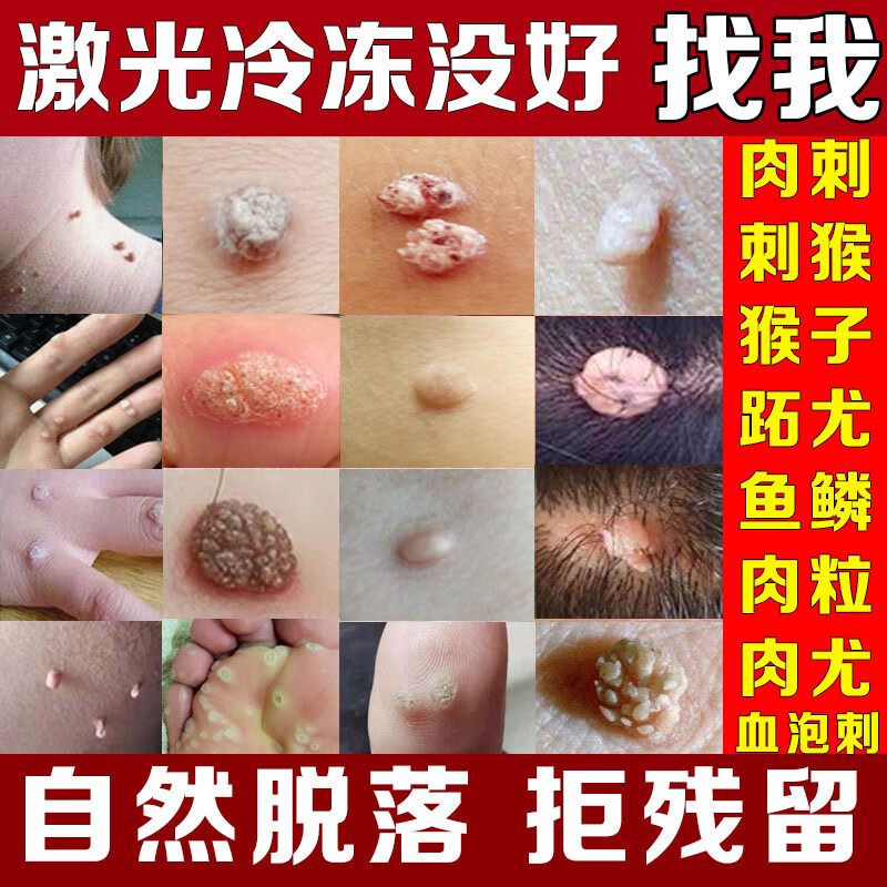 点手上长猴子 脖子小肉粒鱼鳞痣贴血泡肉刺猴跖 刺猴跖疣头