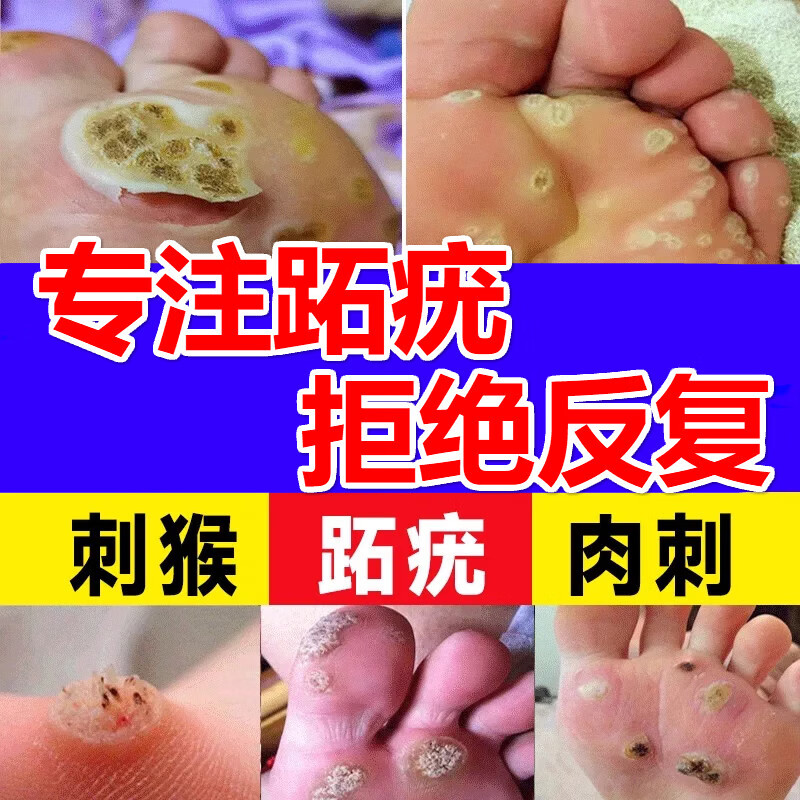跖疣膏药 脚底趾疣足部刺猴脚上垫鸡i眼老茧丝状人群 搭疣扁平疣抗
