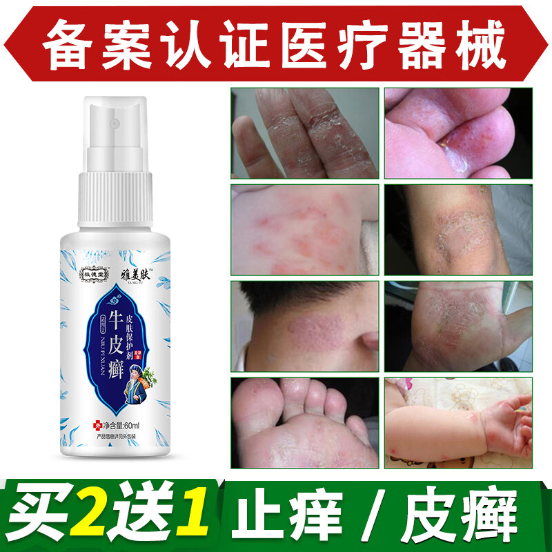 手足藓痒清皮炎湿疹牛皮癣专用苗药顽固牛皮癣银屑i病皮肤癣喷剂体癣药水股癣痒净花斑癣真菌感染疥疮专用膏 癣王喷剂+疥疮膏一支