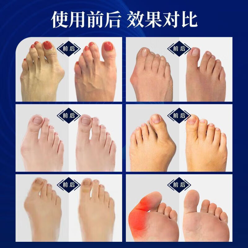 通用【德国研发】脚趾器可调节脚拇指外翻分趾器男女大脚骨效正器  不 【组合搭配】日用辅助+夜用强力