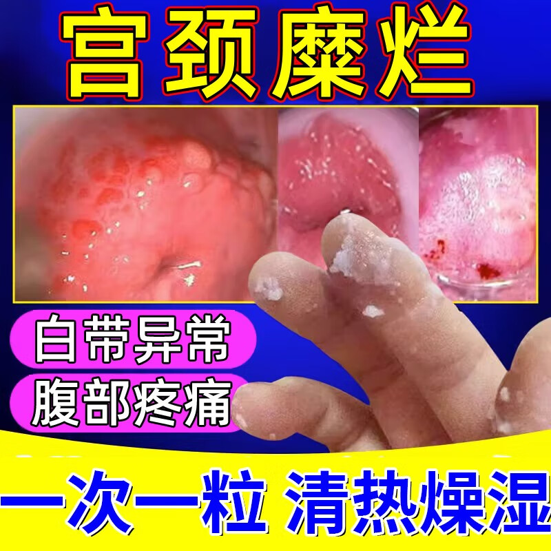 宫颈糜烂妇科用药二度三度 消糜栓宫颈糜烂的药白带增多颜色发黄霉菌