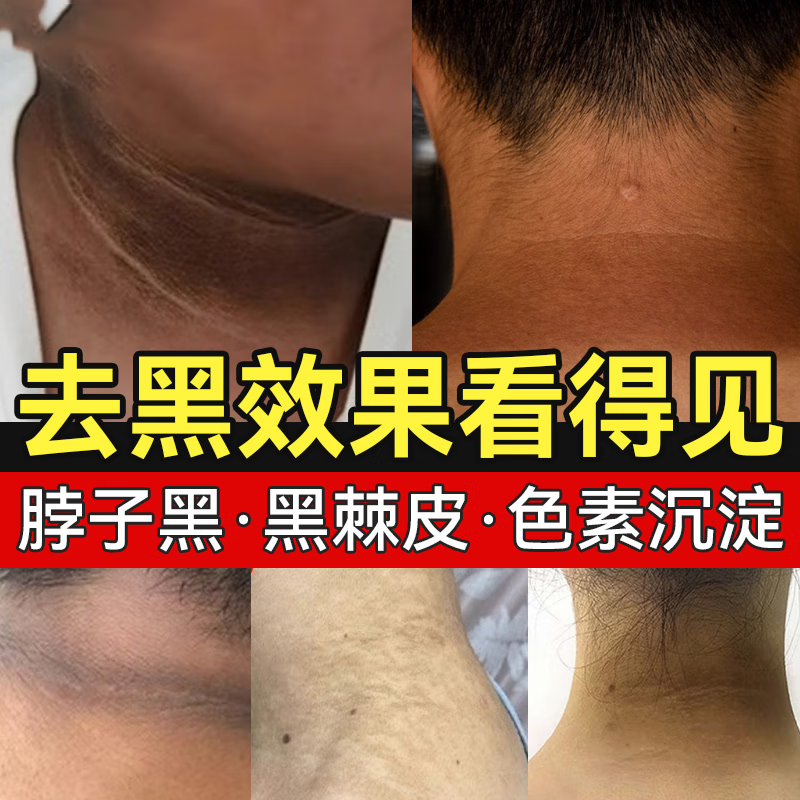 敖东【严选官方店】药房直售儿童脖子黑黑的去黑棘皮症黑脖子除i黑色