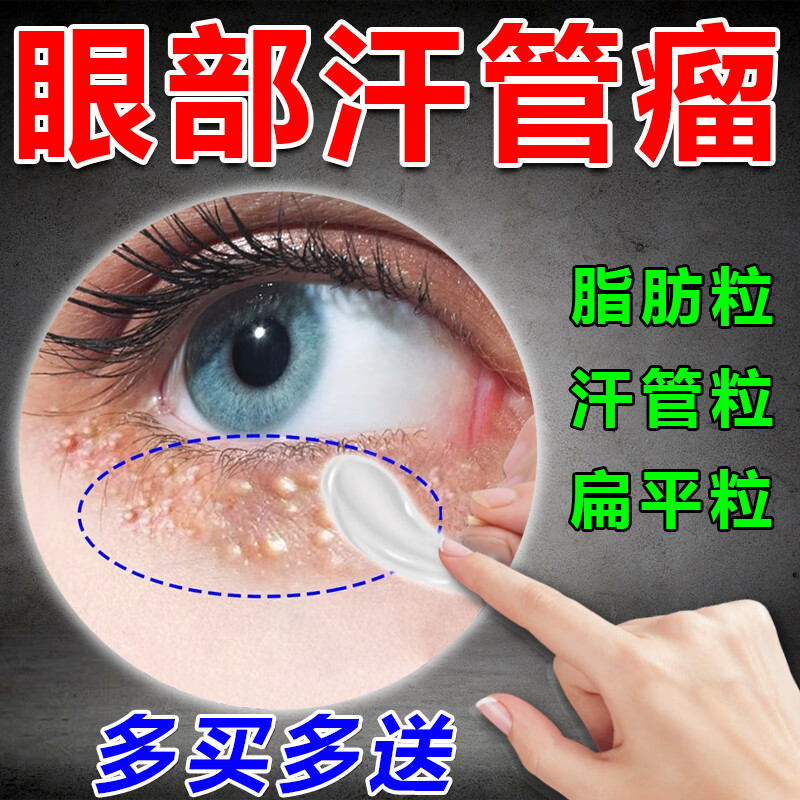 汗管瘤眼部去除神器眼霜脂肪粒白色颗粒油脂粒男女通用专用抑菌膏 单