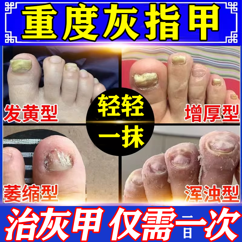 灰指甲药治成人正1專用药膏指甲真菌感染脱甲治疗灰指甲药 硝酸咪康唑