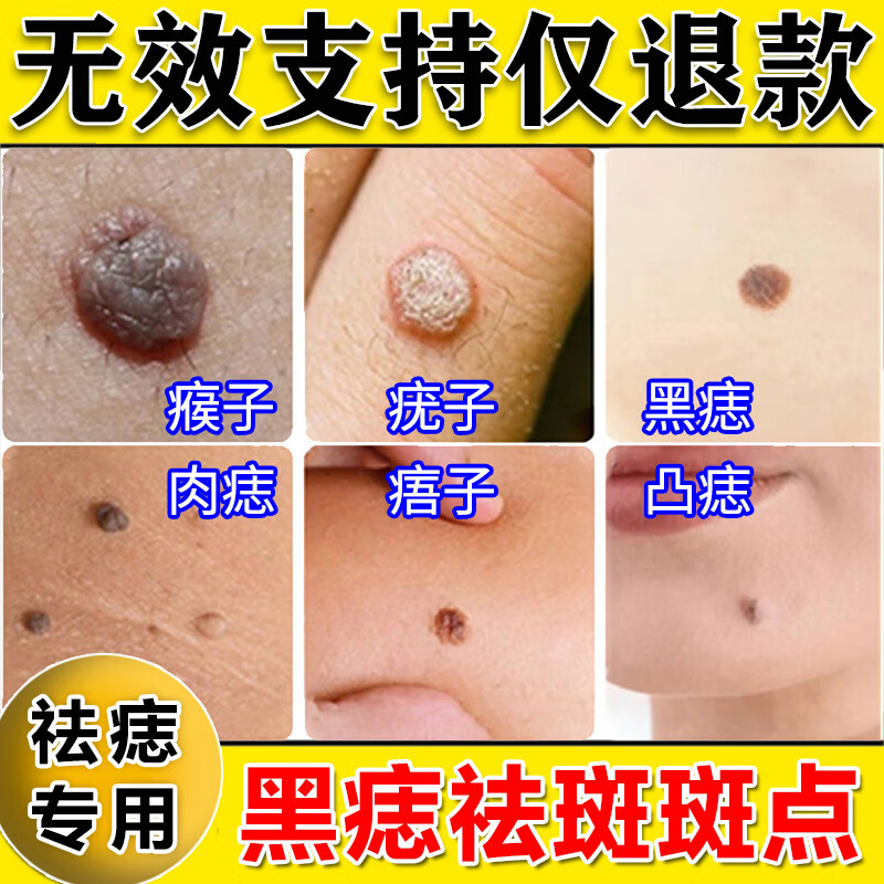 官方正ii品美容院专用点斑膏黑痣脸部疤痕面部无痕点痦子刺瘊黑痣疣脸